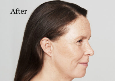 bio-remodelling-after-woman in 40s-side profile photo