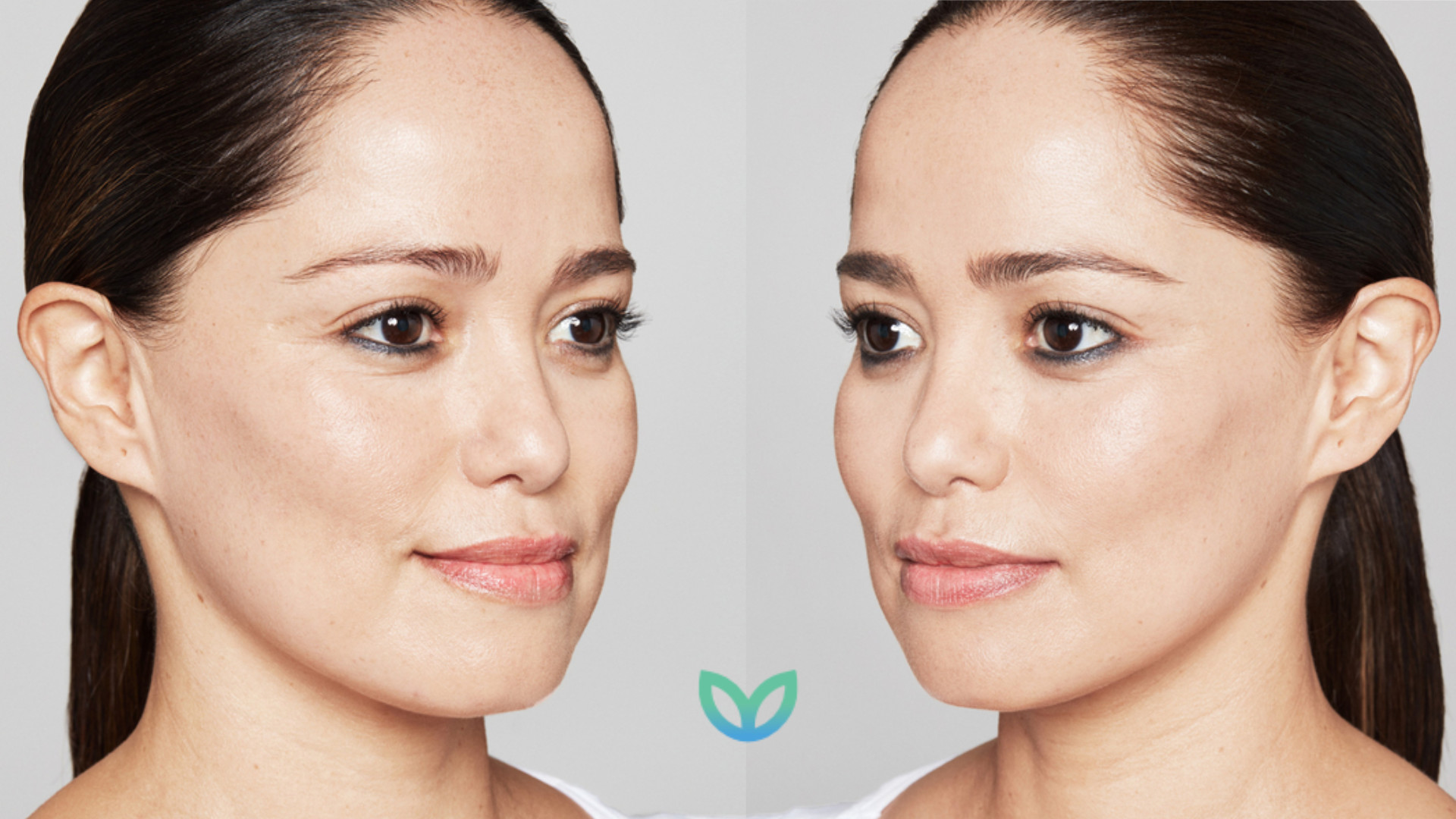 skin boosters woman-before and after treatment bolton